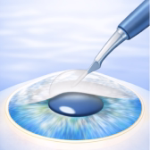 Surgical Epithelial Debridement