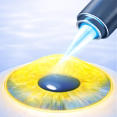 Bandaj lens yerleştirilmesi